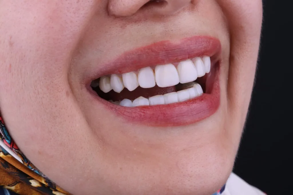 Diş Kaplaması Sonrası Ağrı Nedenleri ve Tedavi Yöntemleri