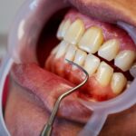 Diş Eti Çekilmesi (2)