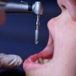 İmplant Abutment Nasıl Yerleştirilir