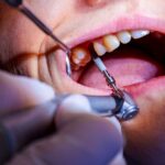 İmplant Tedavisi Acıtır mı