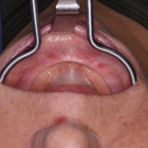 ankara all on four implant