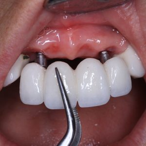 Ankara Anında İmplant