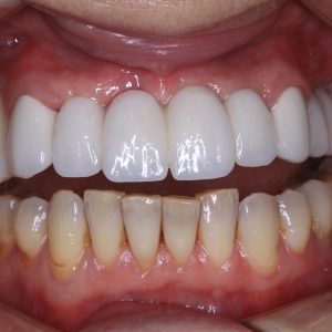 Ankara Anında İmplant