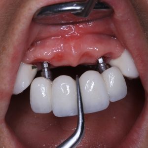 Ankara Anında İmplant