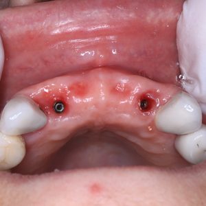 Ankara Anında İmplant