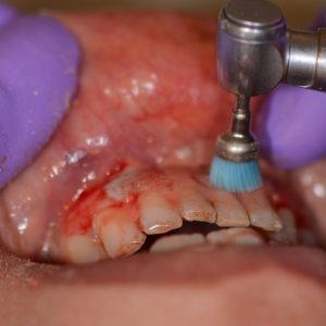 Ankara Düşük Doz Lazer 1