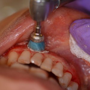 Ankara Düşük Doz Lazer 1