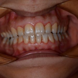 Ankara Düşük Doz Lazer 3