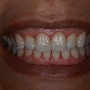 Ankara Düşük Doz Lazer 4