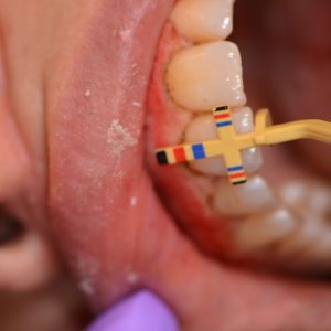 Ankara Düşük Doz Lazer