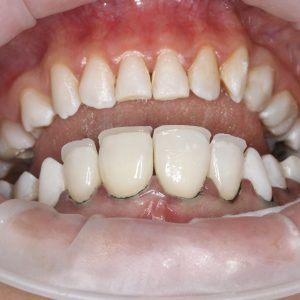 Ankara Kompozit Lamina 1