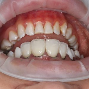 Ankara Kompozit Lamina 2