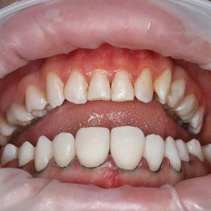 Ankara Kompozit Lamina