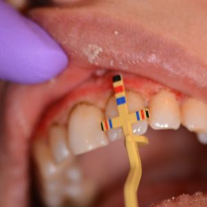 Ankara Lazerle Dişeti Tedavisi