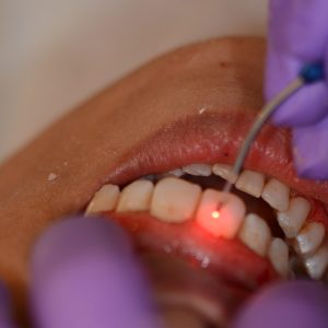 Ankara Lazerle Dişeti Tedavisi