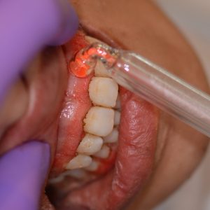 Ankara Lazerle Dişeti Tedavisi