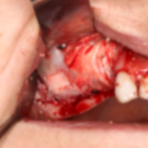 Ankara Sinüs Lifting