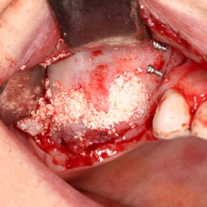 Ankara Sinüs Lifting