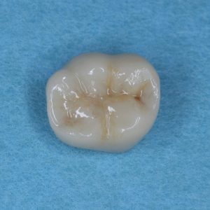 Ankara Zirkonyum Tedavisi