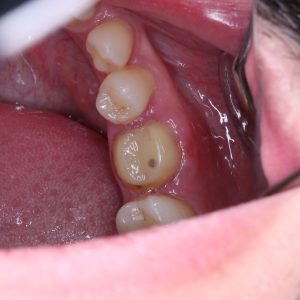 Ankara Zirkonyum Tedavisi