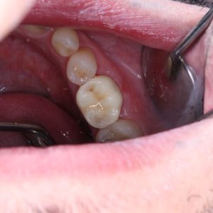 Ankara Zirkonyum Tedavisi