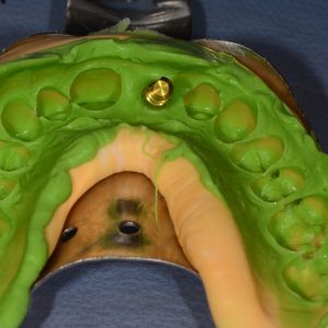 Implant Üstü Ölçü 1