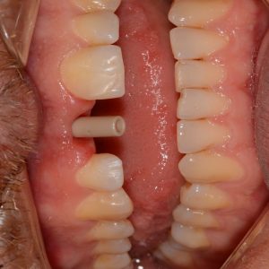 Implant Üstü Ölçü 2