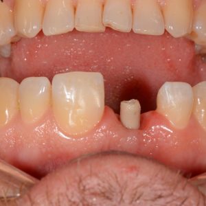 Implant Üstü Ölçü 4