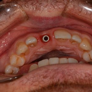 Implant Üstü Ölçü 5