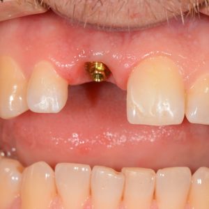 Implant Üstü Ölçü 6