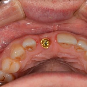 Implant Üstü Ölçü