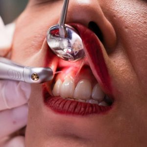 Lazer ile Gingivektomi (2)