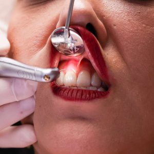 Lazer ile Gingivektomi