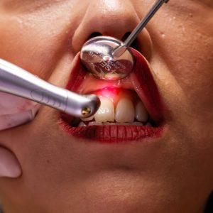 Lazerle Diş Eti Tedavisi