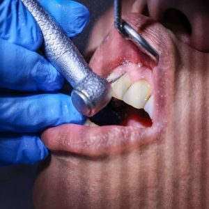 Porselen Lamina Kesimi